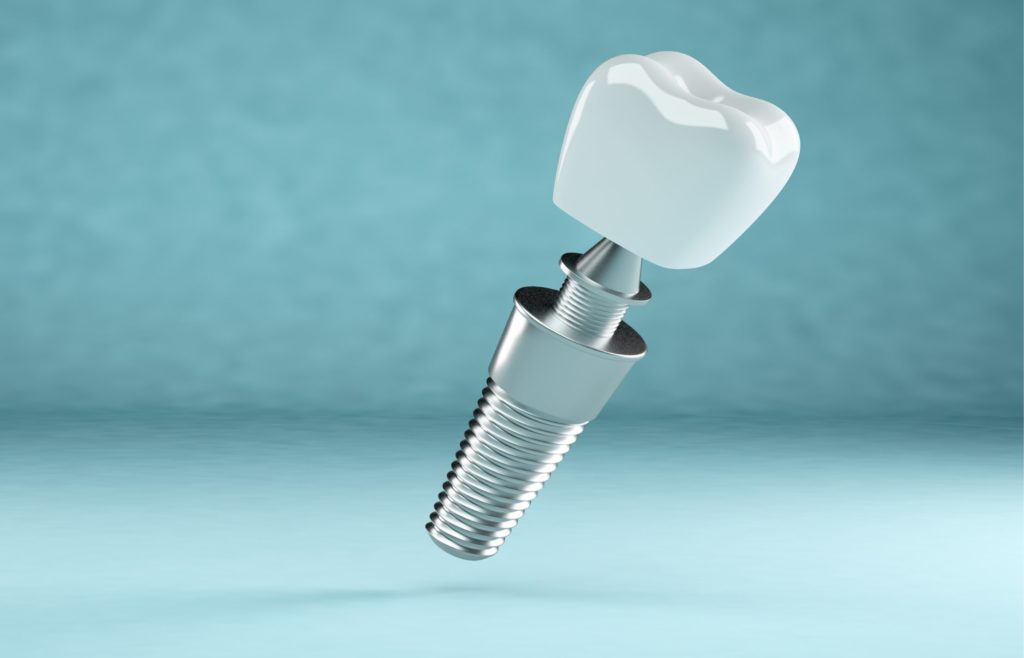 3D Implant Render